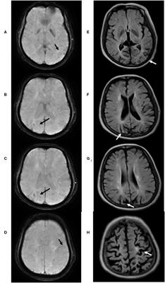 Superficial Siderosis and Microbleed Restricted in Cortex Might Be Correlated to Atrophy and Cognitive Decline in Sneddon's Syndrome